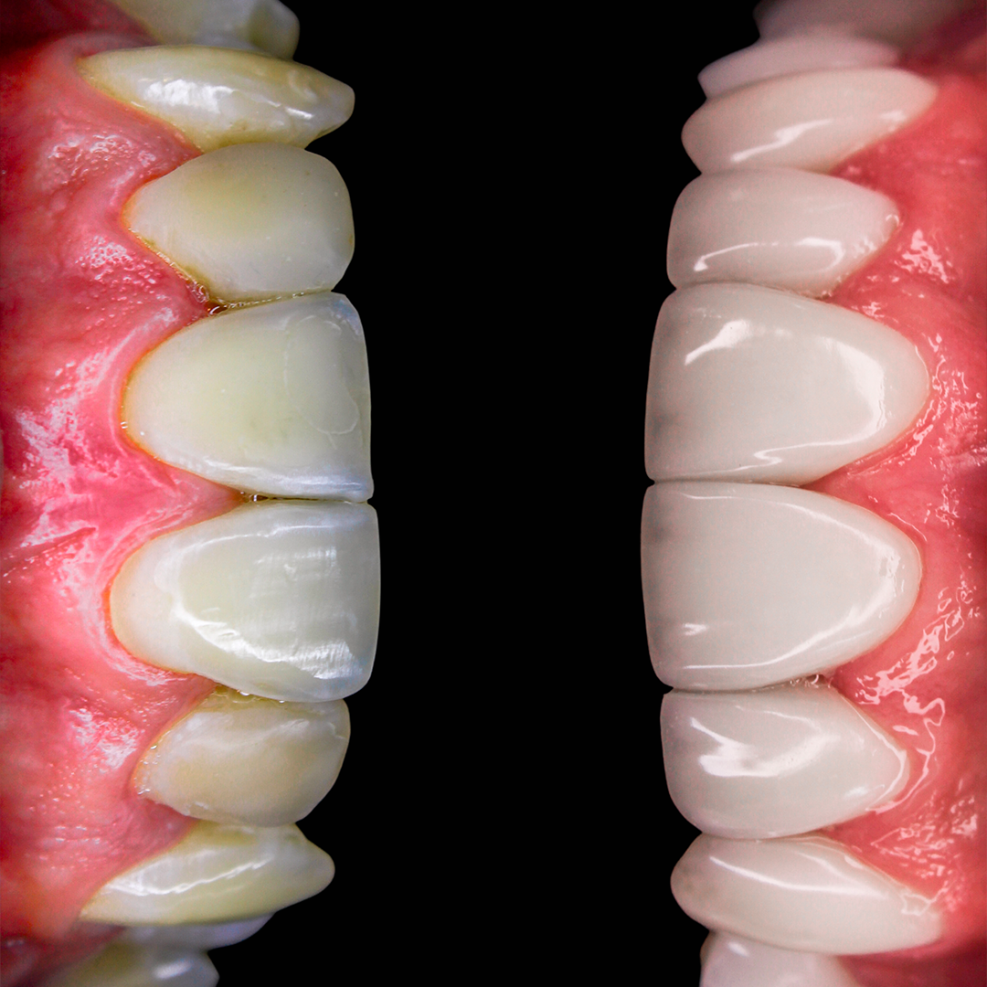 Close de um sorriso com dentes claros e alinhados