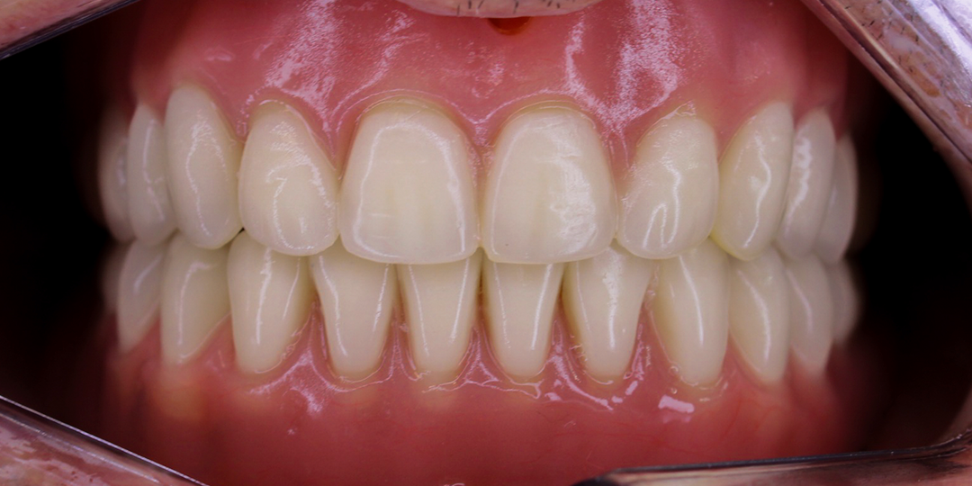Implantes na Seja Mais Odontologia