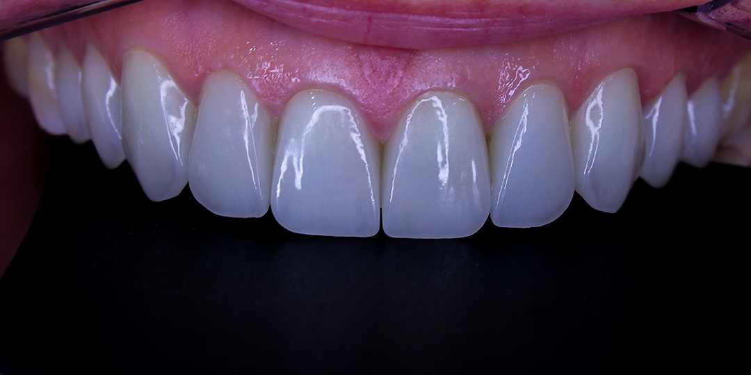 Lentes de porcelana na Seja Mais Odontologia