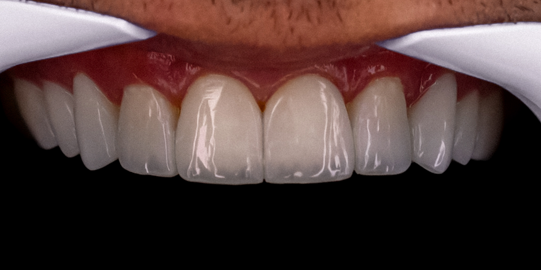 Facetas em resina na Seja Mais Odontologia
